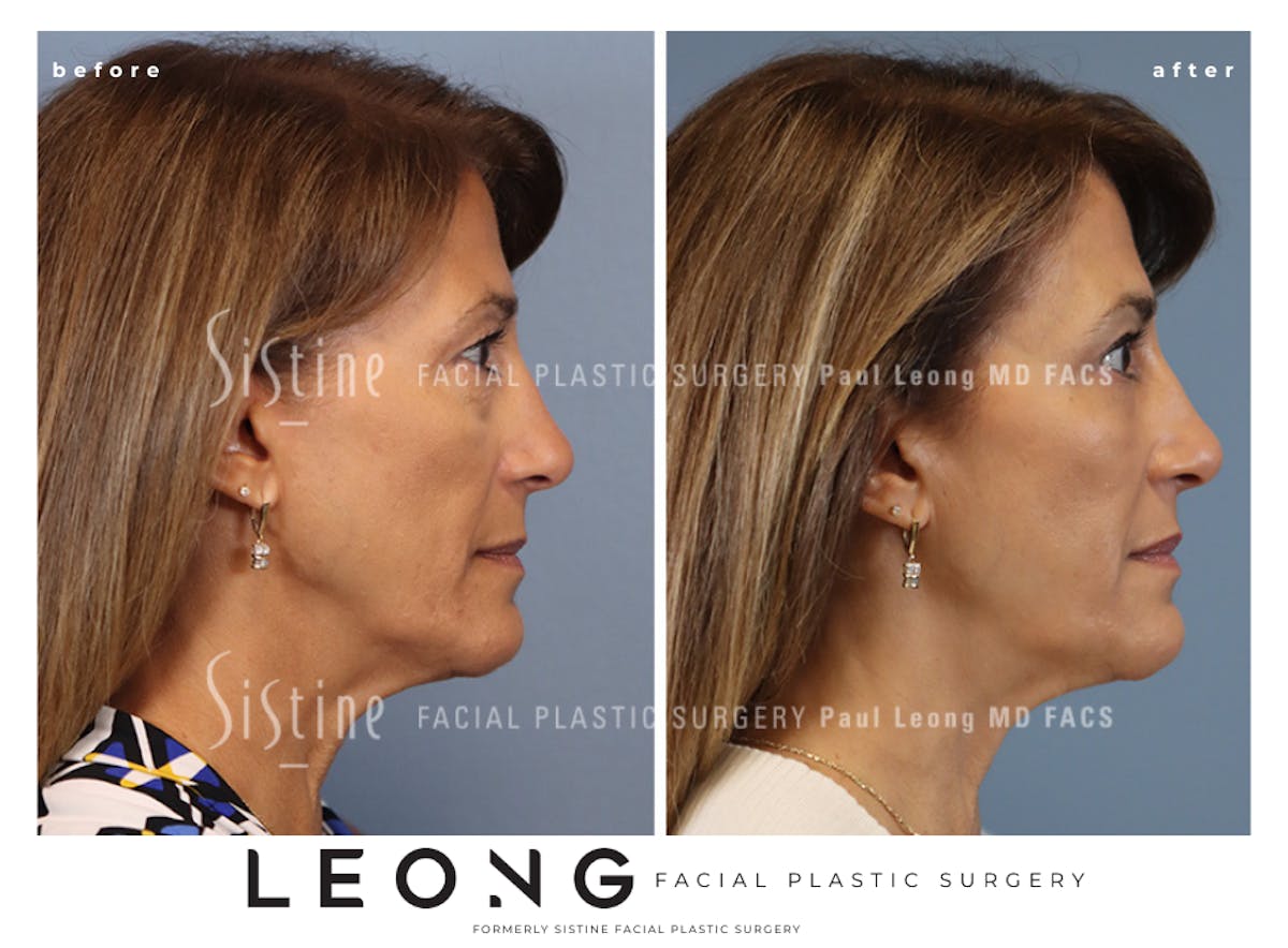 Blepharoplasty Before & After Gallery - Patient 365603 - Image 4