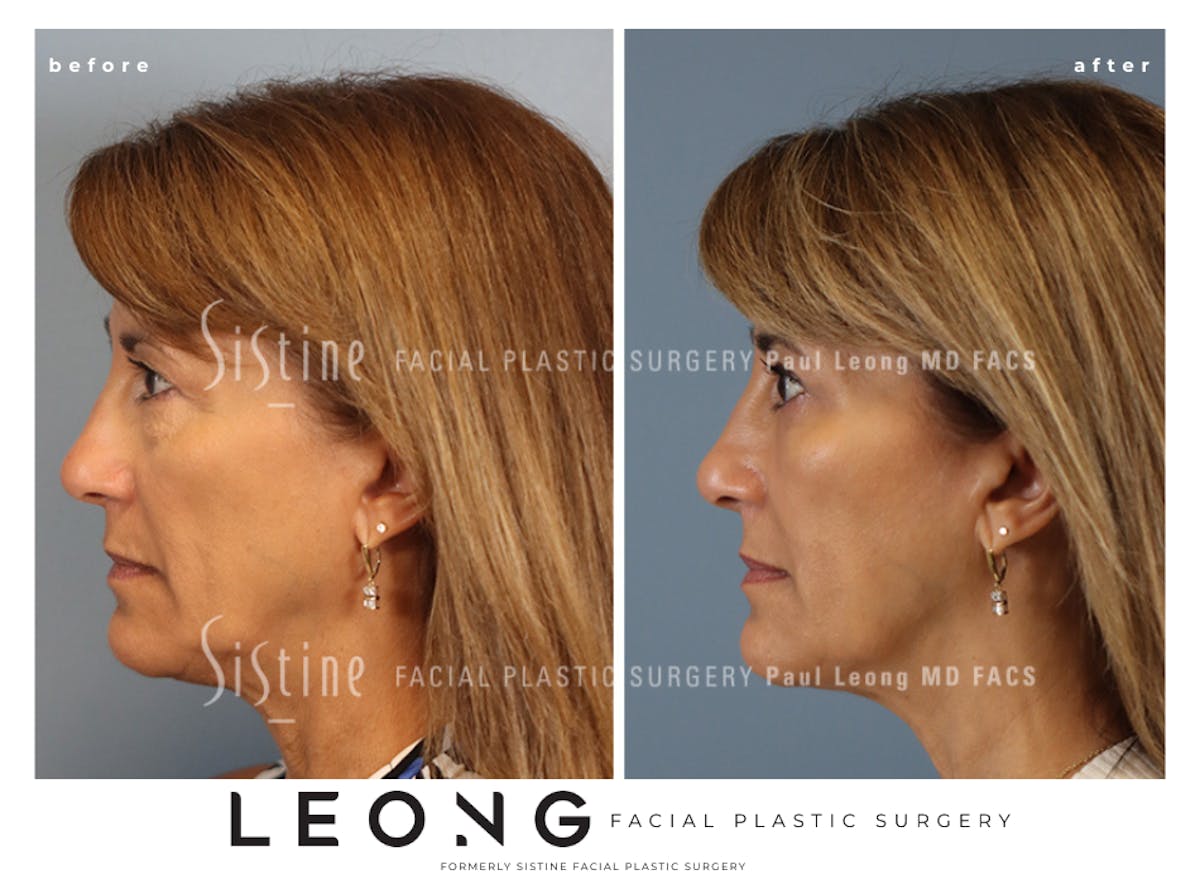 Blepharoplasty Before & After Gallery - Patient 365603 - Image 5