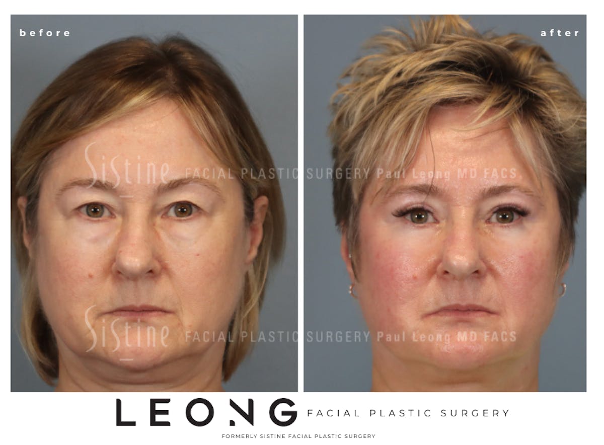 Blepharoplasty Before & After Gallery - Patient 382159 - Image 1
