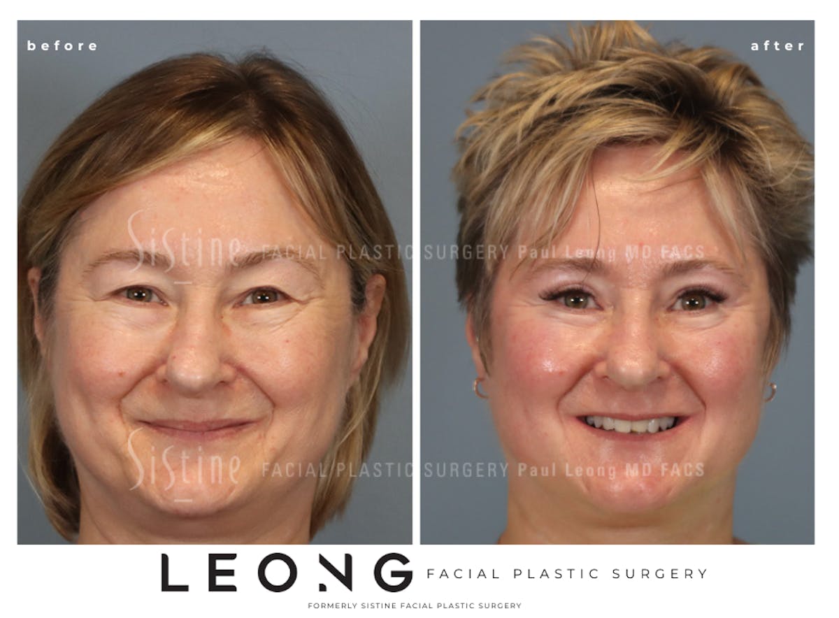 Blepharoplasty Before & After Gallery - Patient 382159 - Image 2