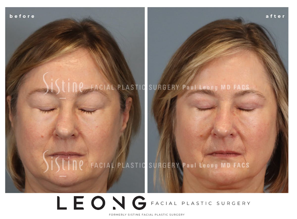 Blepharoplasty Before & After Gallery - Patient 382159 - Image 3