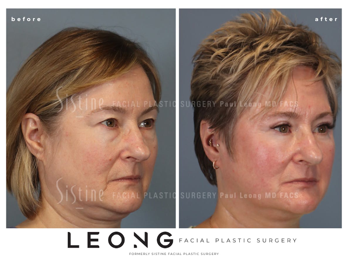 Blepharoplasty Before & After Gallery - Patient 382159 - Image 4