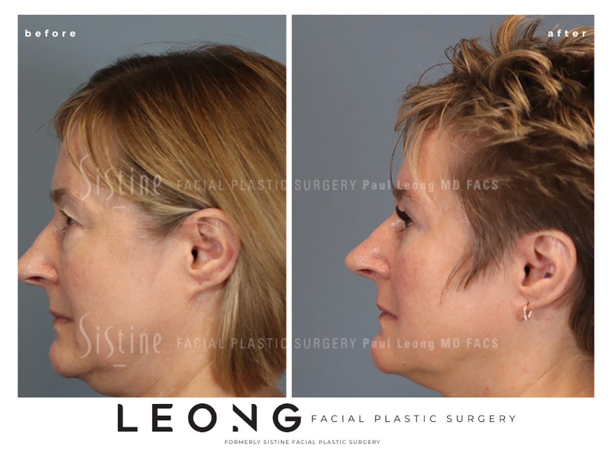 Blepharoplasty Before & After Gallery - Patient 382159 - Image 5