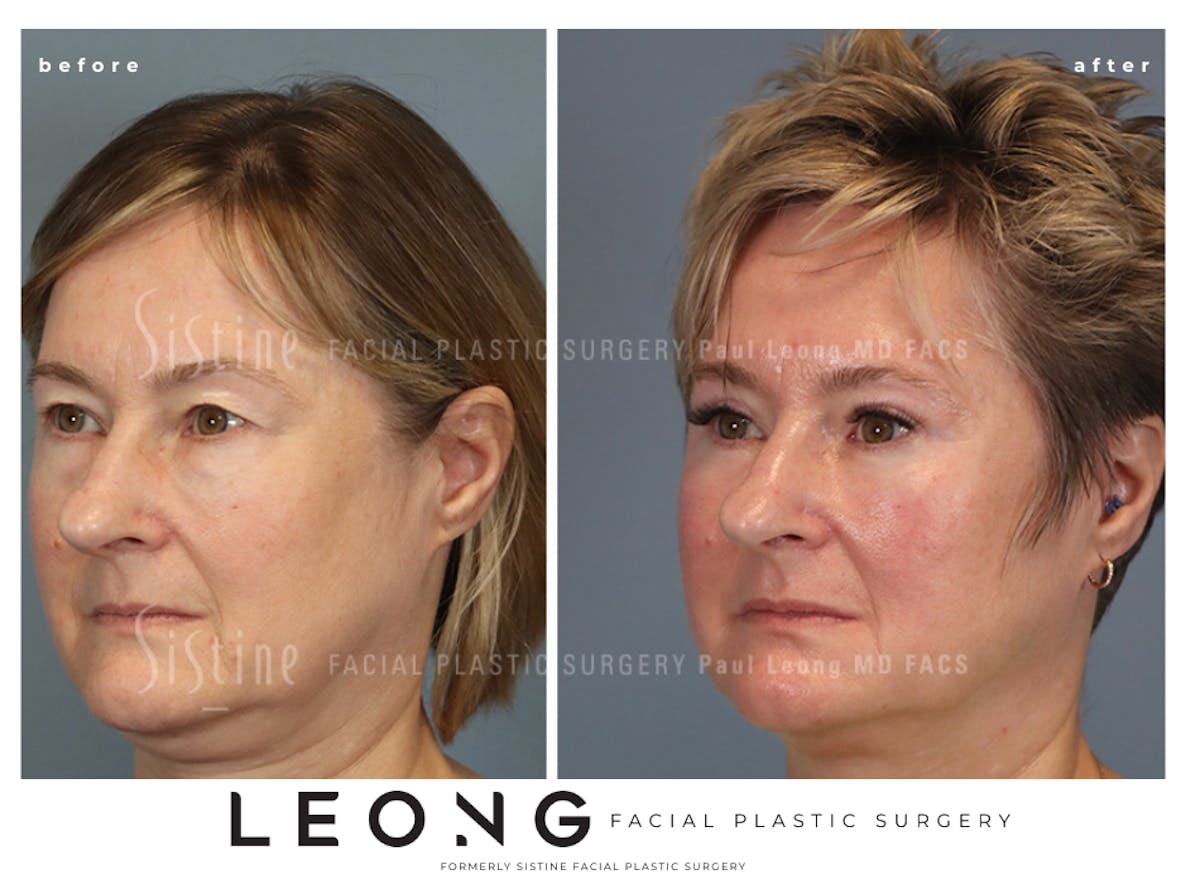 Blepharoplasty Before & After Gallery - Patient 382159 - Image 6