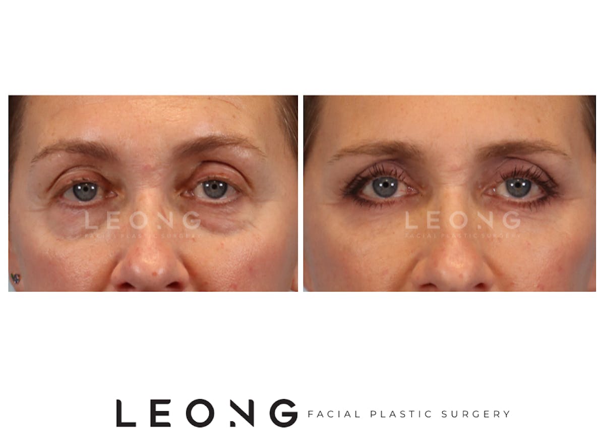 Blepharoplasty Before & After Gallery - Patient 387699 - Image 1