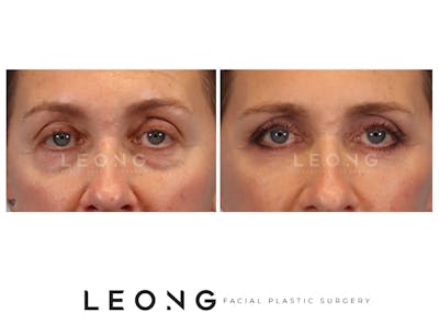 Blepharoplasty Before & After Gallery - Patient 387699 - Image 1