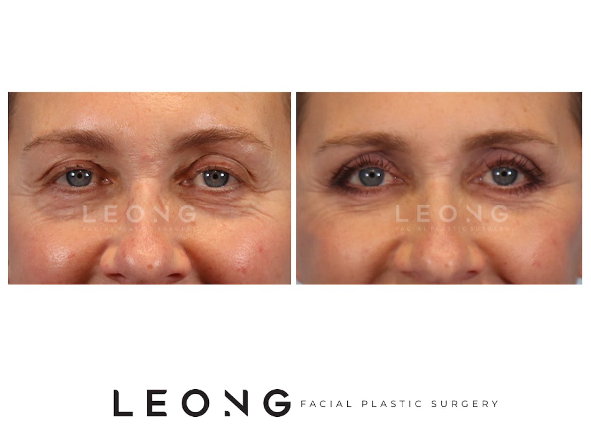 Blepharoplasty Before & After Gallery - Patient 387699 - Image 2