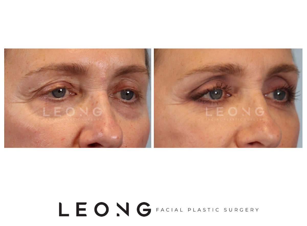 Blepharoplasty Before & After Gallery - Patient 387699 - Image 3