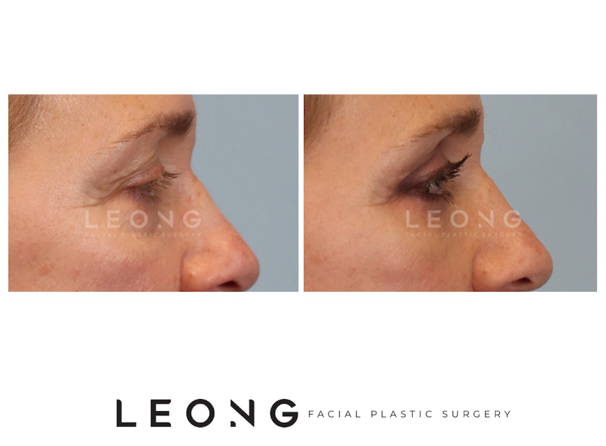 Blepharoplasty Before & After Gallery - Patient 387699 - Image 4