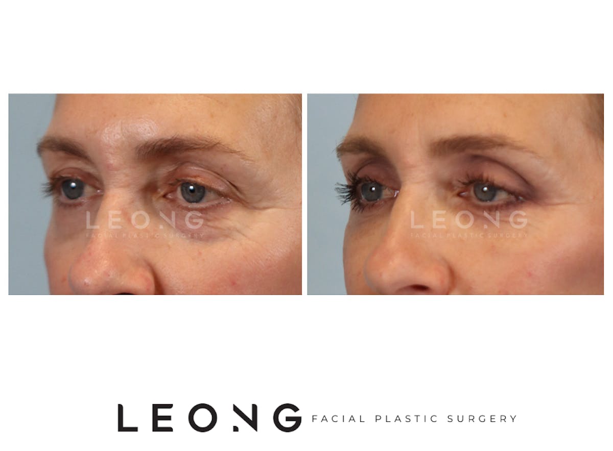 Blepharoplasty Before & After Gallery - Patient 387699 - Image 5