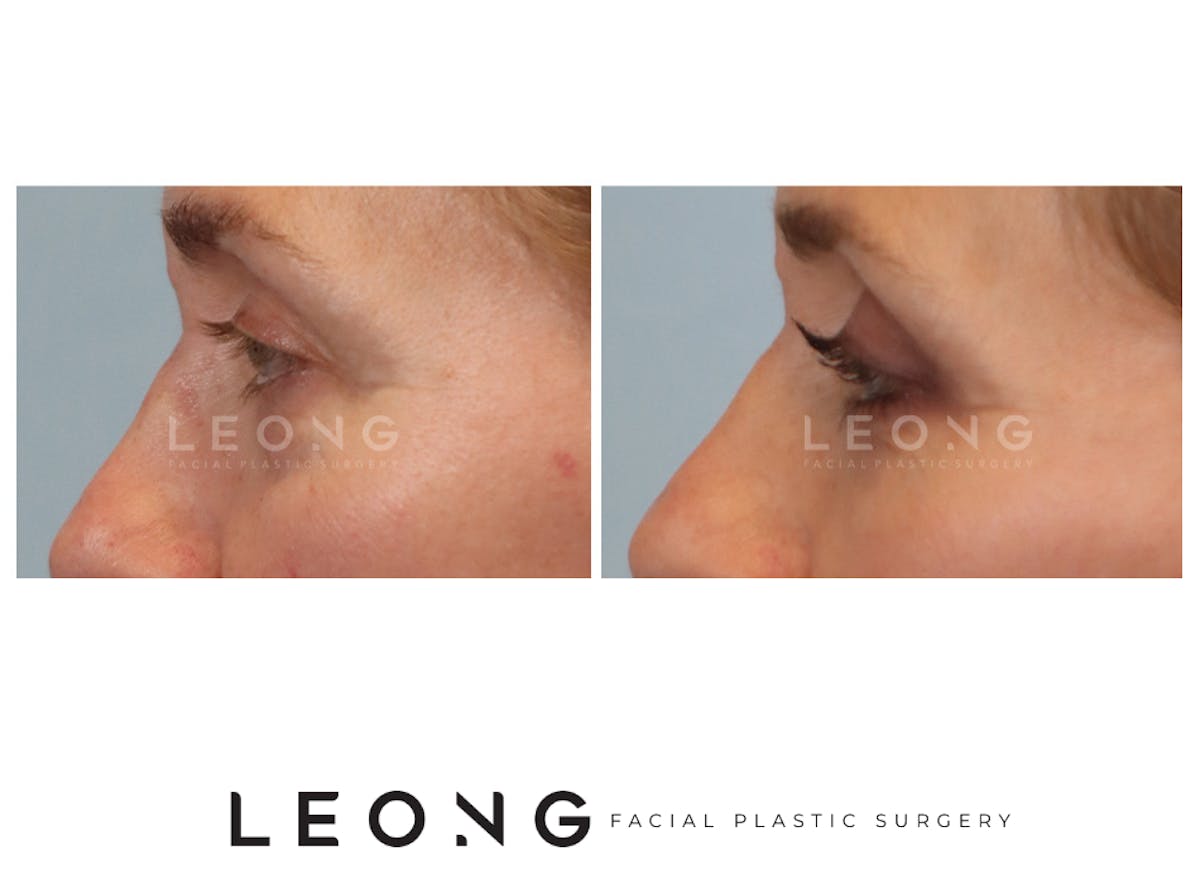 Blepharoplasty Before & After Gallery - Patient 387699 - Image 6
