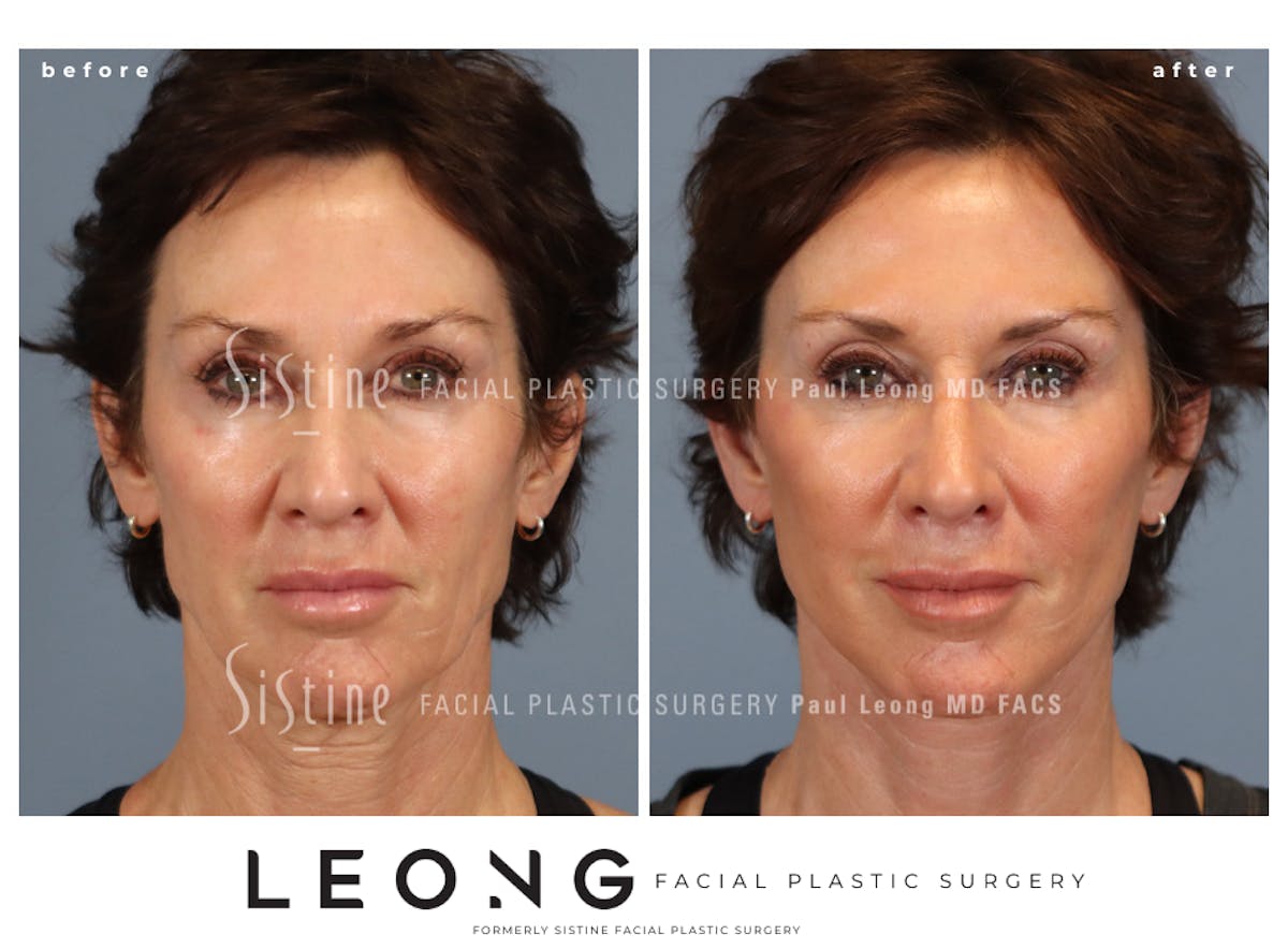 Facelift Before & After Gallery - Patient 304942 - Image 3