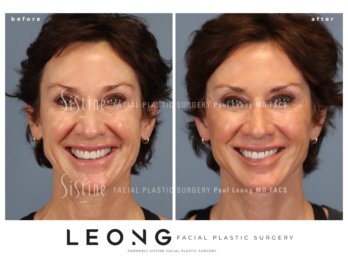 Facelift Before & After Gallery - Patient 304942 - Image 4