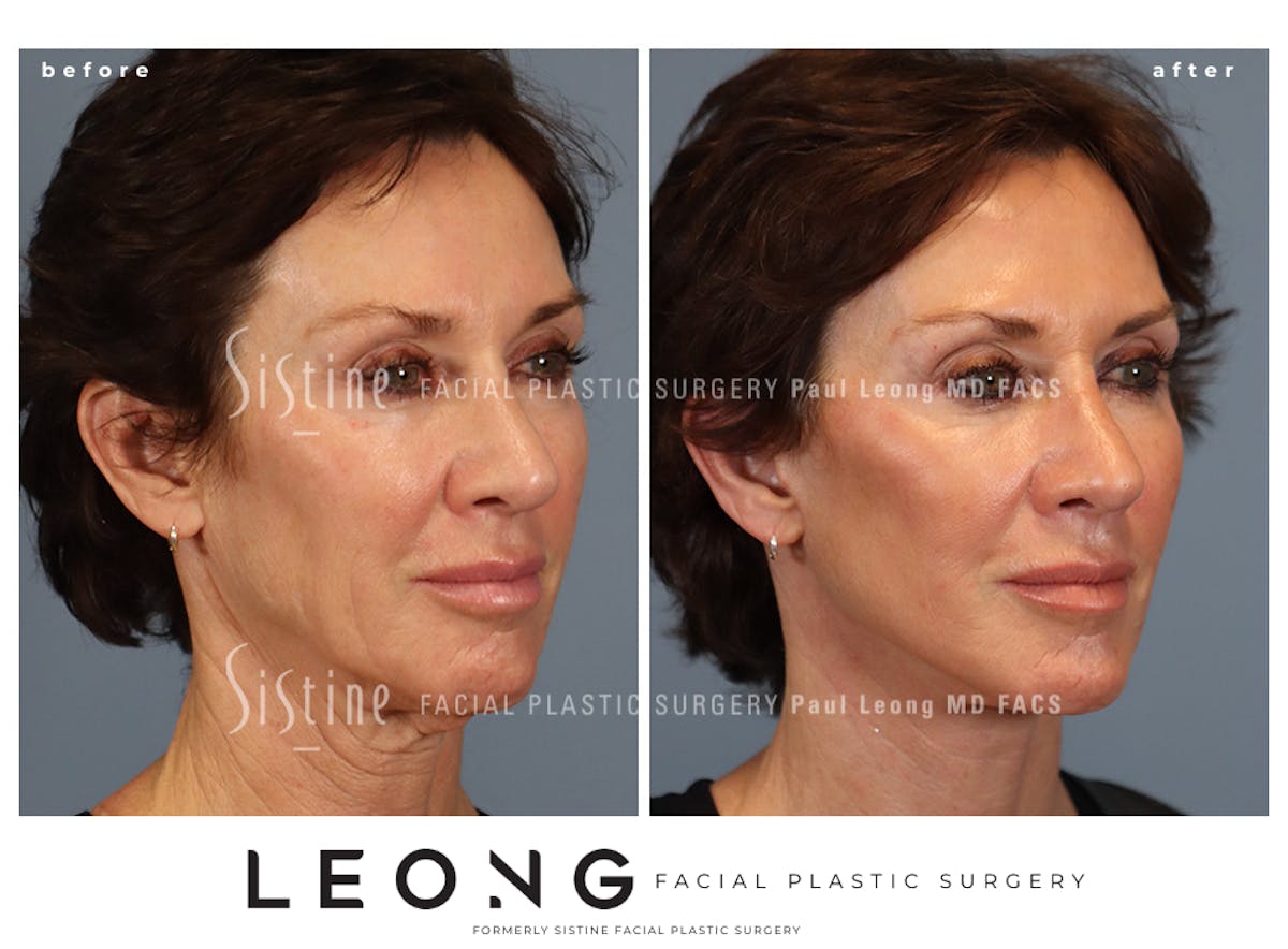 Facelift Before & After Gallery - Patient 304942 - Image 1