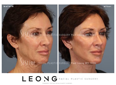 Facelift Before & After Gallery - Patient 304942 - Image 1