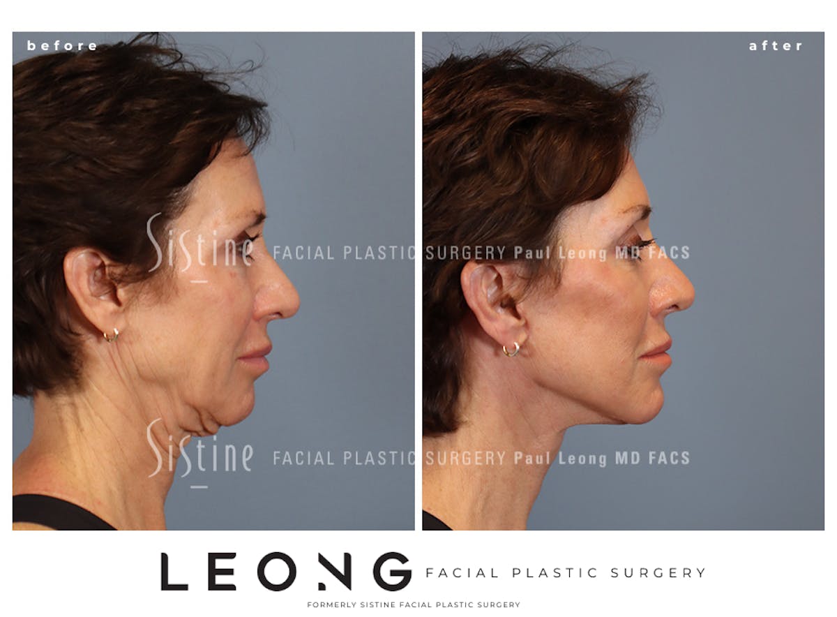 Facelift Before & After Gallery - Patient 304942 - Image 5