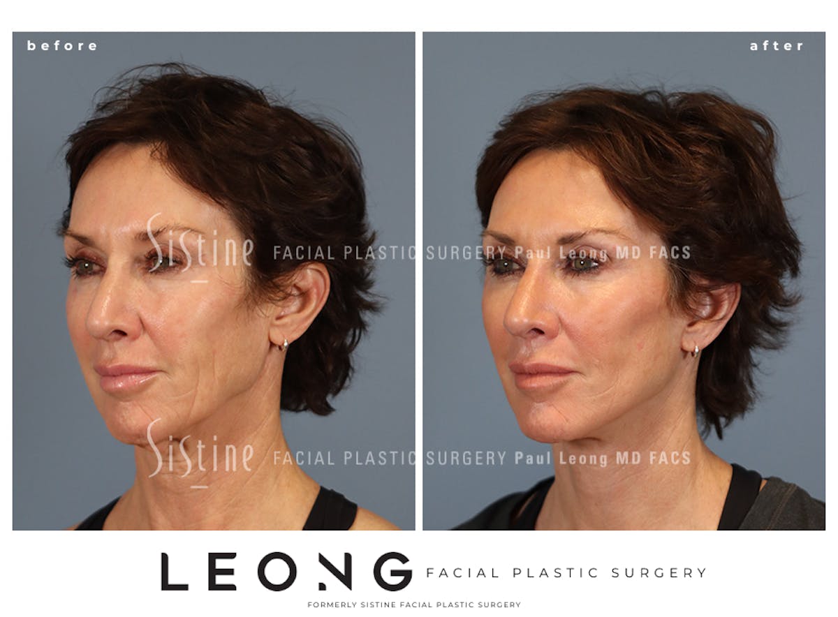 Facelift Before & After Gallery - Patient 304942 - Image 6