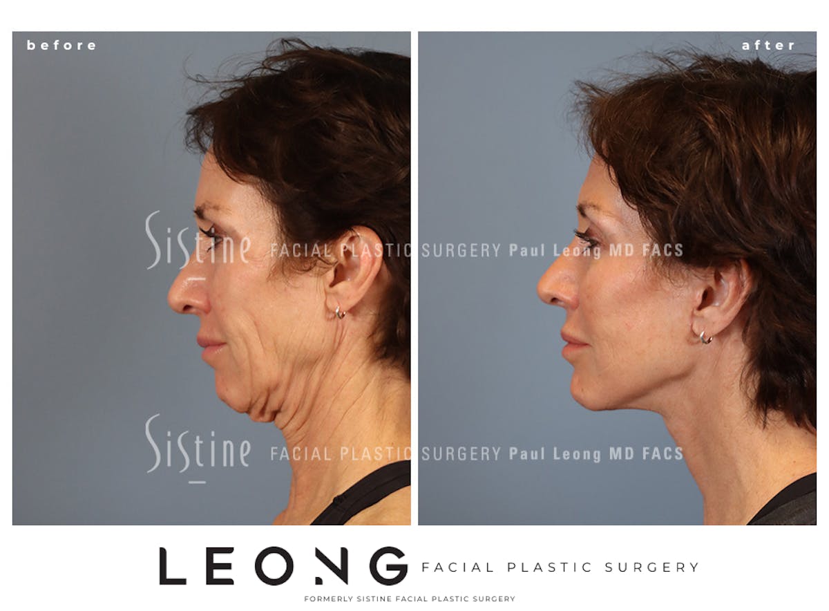 Facelift Before & After Gallery - Patient 304942 - Image 2