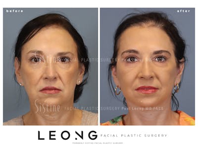 Facelift Before & After Gallery - Patient 235559 - Image 1