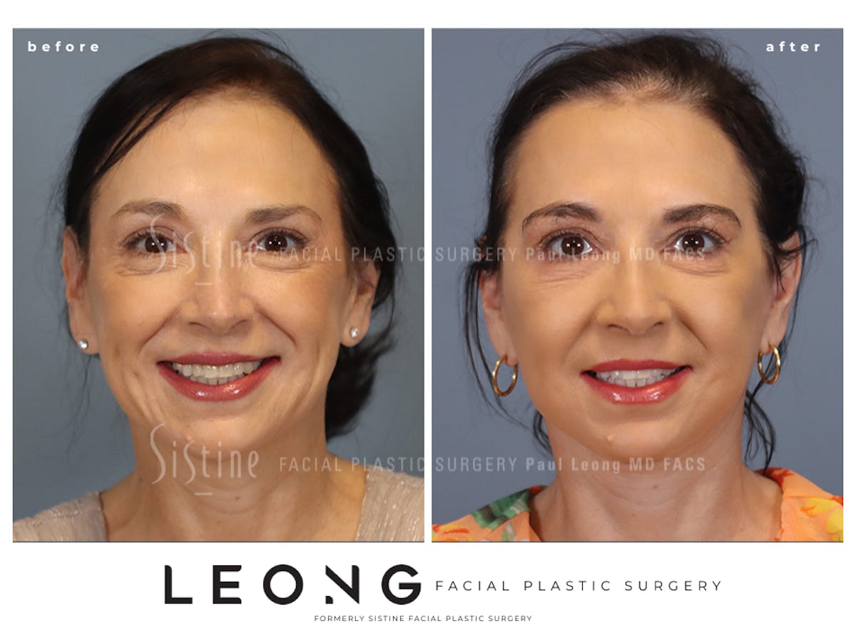 Facelift Before & After Gallery - Patient 235559 - Image 3