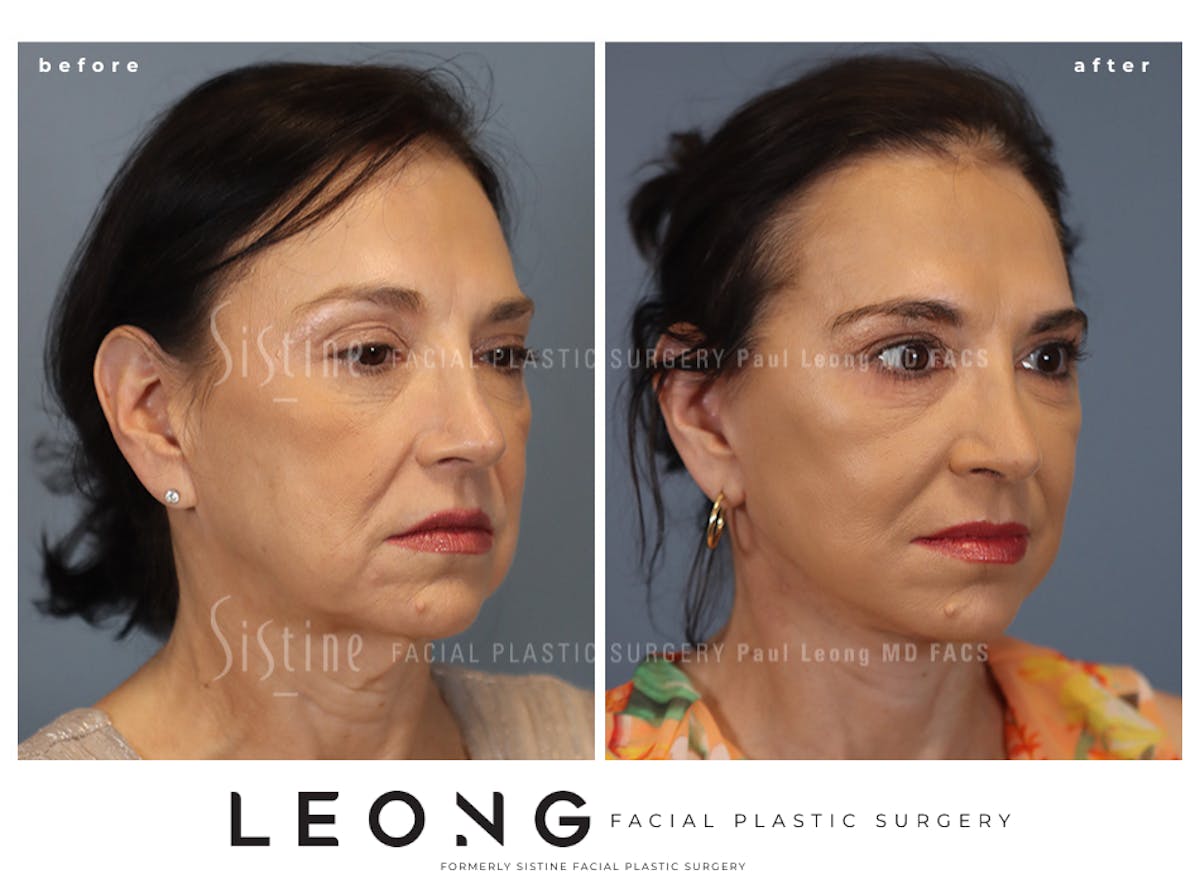 Facelift Before & After Gallery - Patient 235559 - Image 4