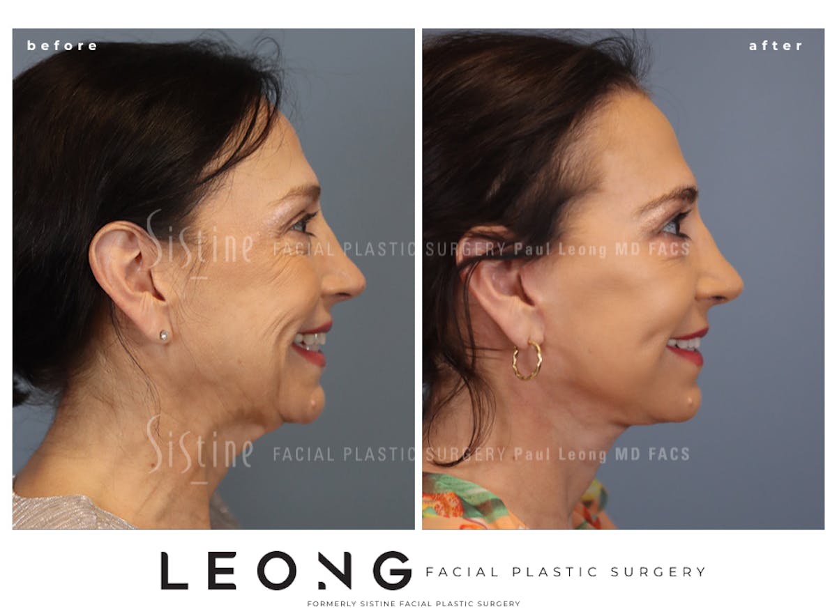 Facelift Before & After Gallery - Patient 235559 - Image 5