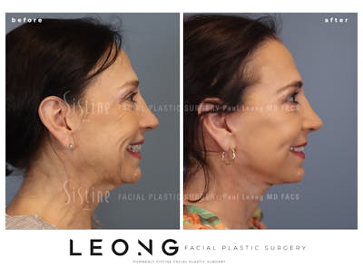 Deep Neck Lift Before & After Gallery - Patient 333506 - Image 1