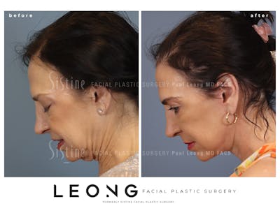 Facelift Before & After Gallery - Patient 235559 - Image 1
