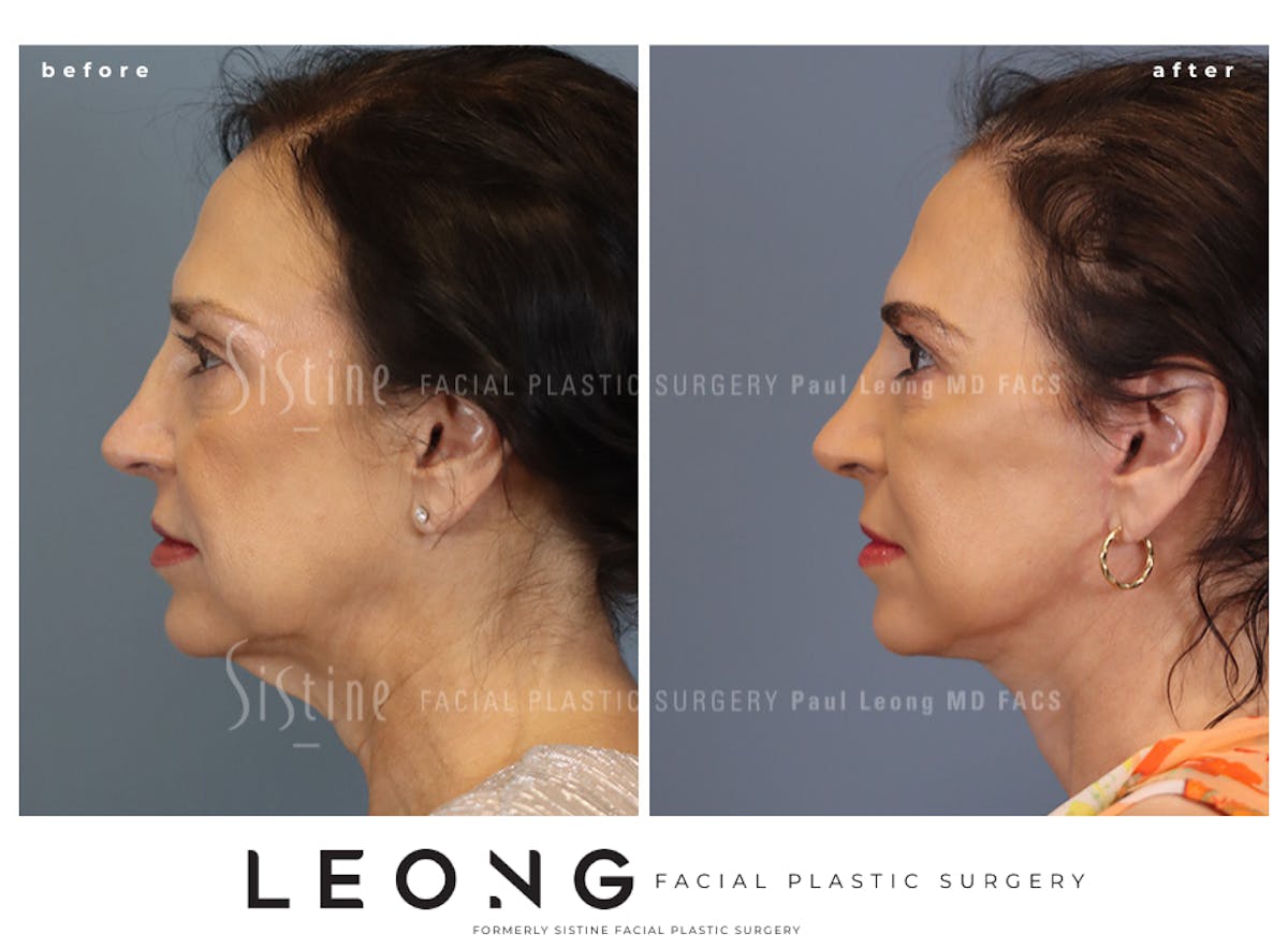 Facelift Before & After Gallery - Patient 235559 - Image 6