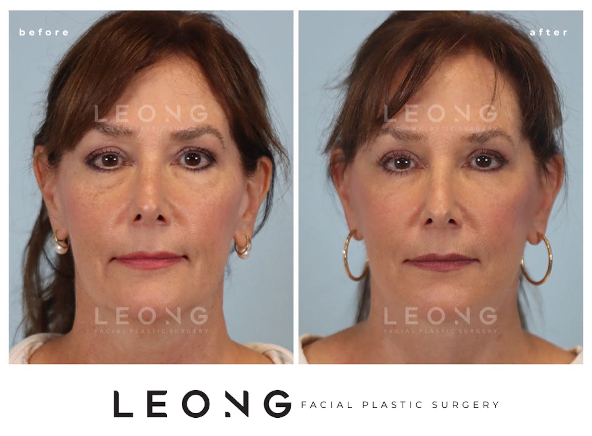 Facelift Before & After Gallery - Patient 767837 - Image 2