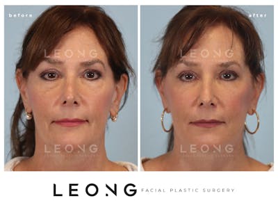 Facelift Before & After Gallery - Patient 767837 - Image 1