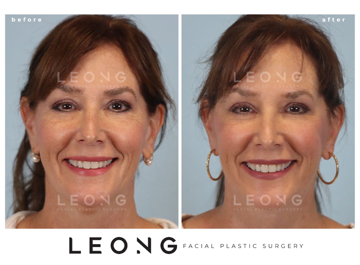 Facelift Before & After Gallery - Patient 767837 - Image 3