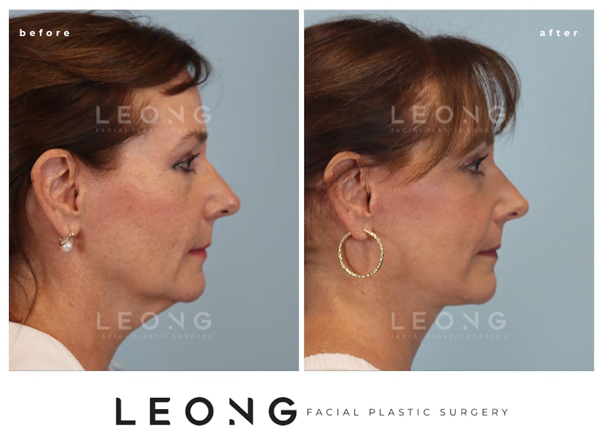 Facelift Before & After Gallery - Patient 767837 - Image 1