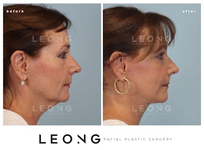 Facelift Before & After Gallery - Patient 767837 - Image 1