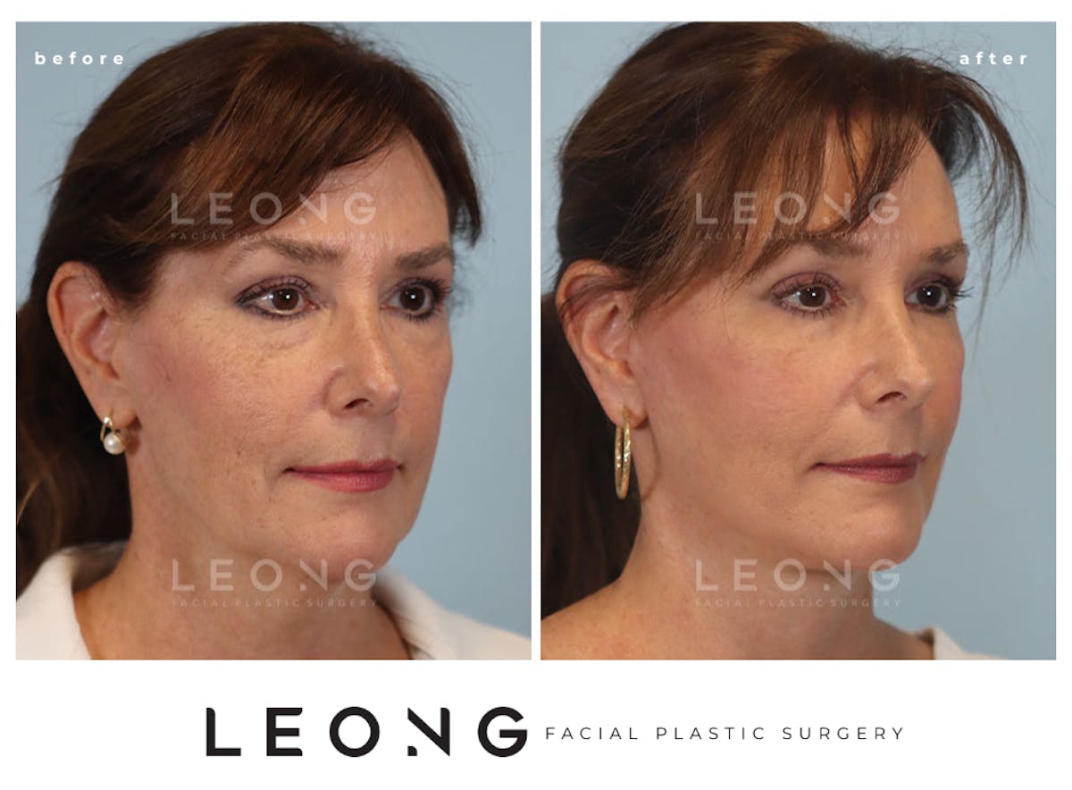 Facelift Before & After Gallery - Patient 767837 - Image 4