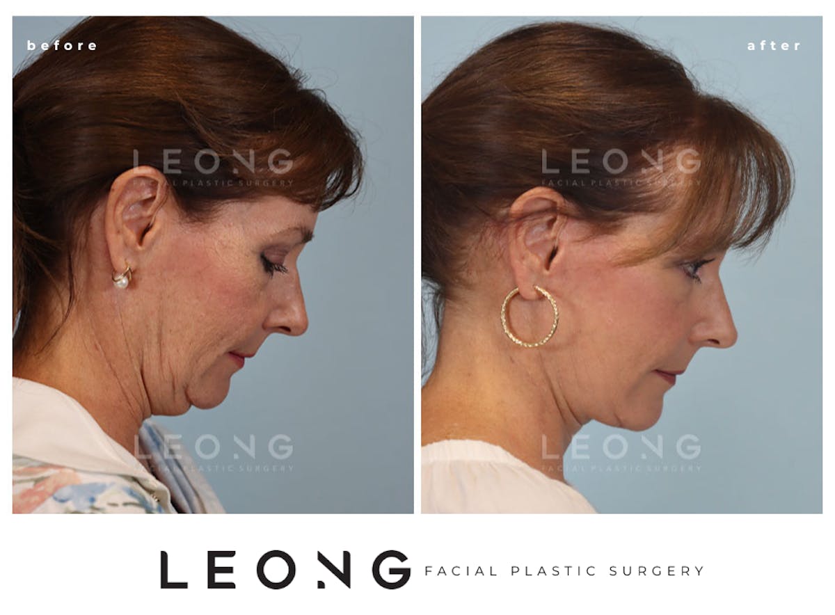 Facelift Before & After Gallery - Patient 767837 - Image 5