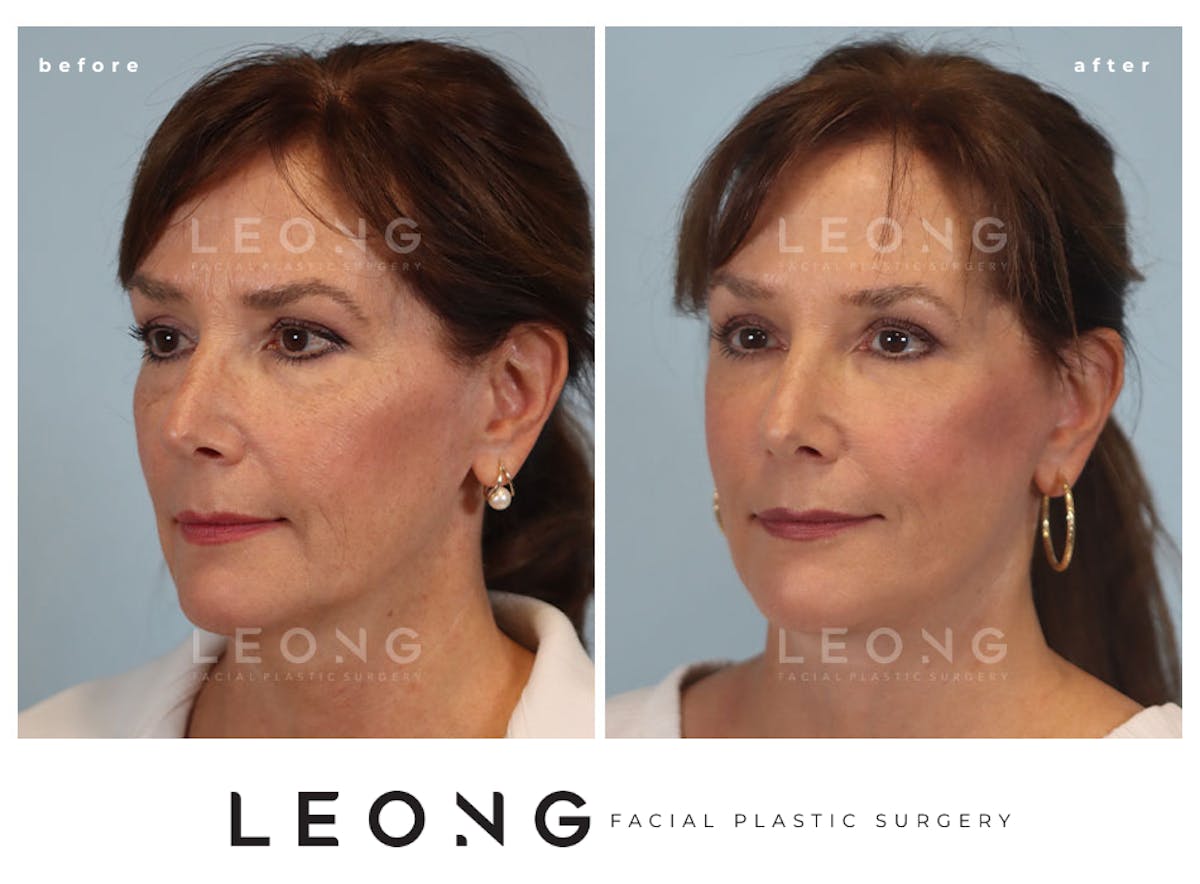 Facelift Before & After Gallery - Patient 767837 - Image 6