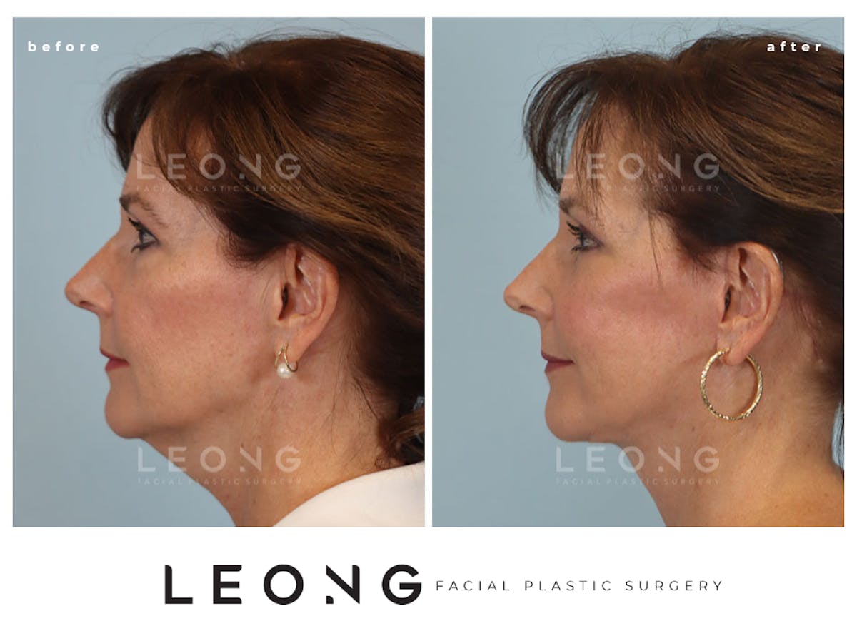 Facelift Before & After Gallery - Patient 767837 - Image 7