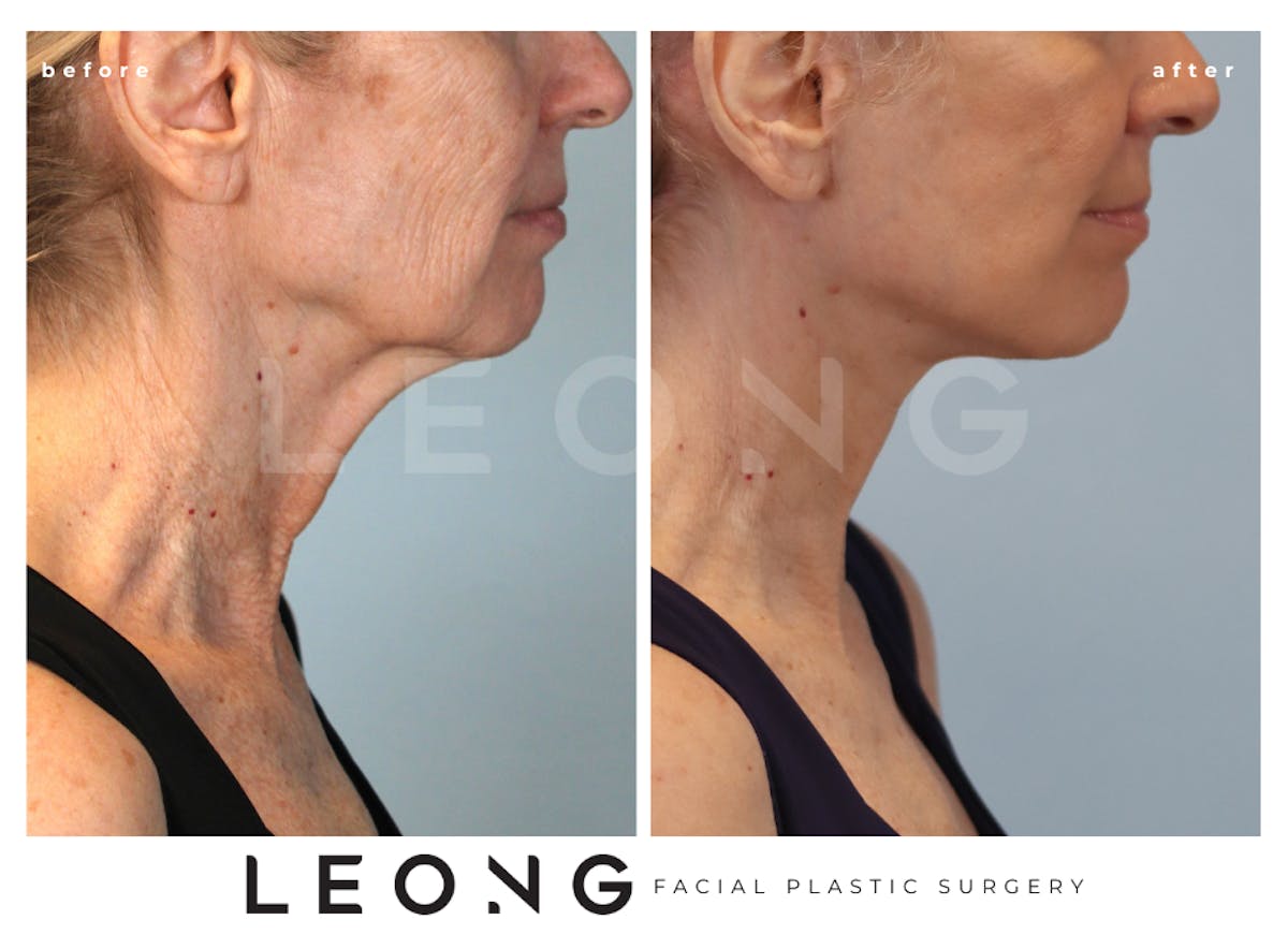Facelift Before & After Gallery - Patient 238132 - Image 1