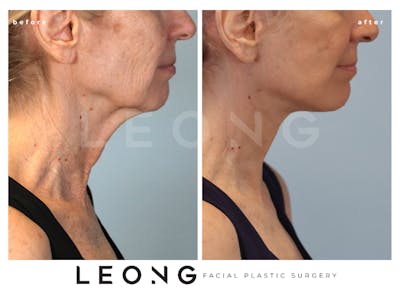 Facelift Before & After Gallery - Patient 238132 - Image 1