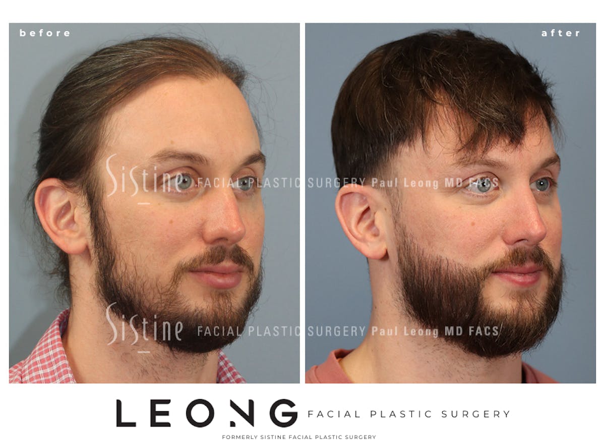 Hair Transplant Before & After Gallery - Patient 230510 - Image 1