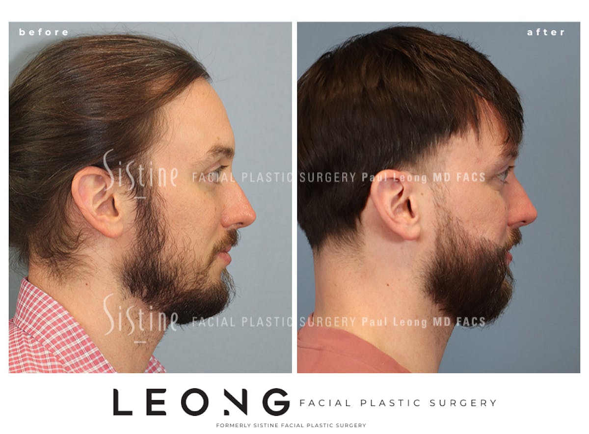 Hair Transplant Before & After Gallery - Patient 230510 - Image 2