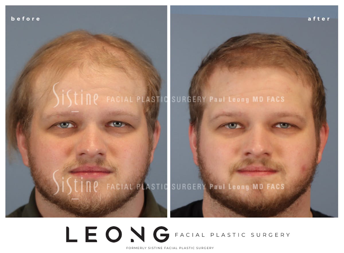 Hair Transplant Before & After Gallery - Patient 297398 - Image 1