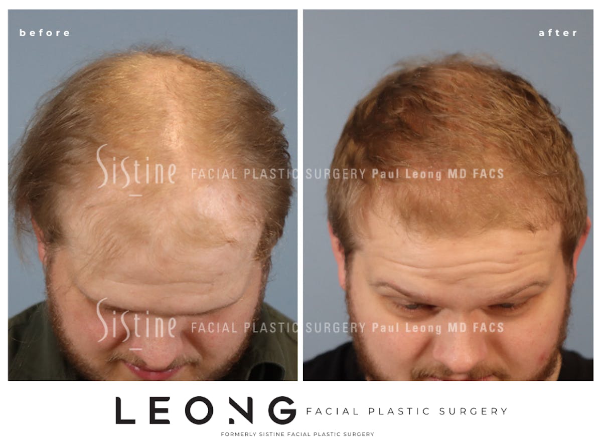 Hair Transplant Before & After Gallery - Patient 297398 - Image 2