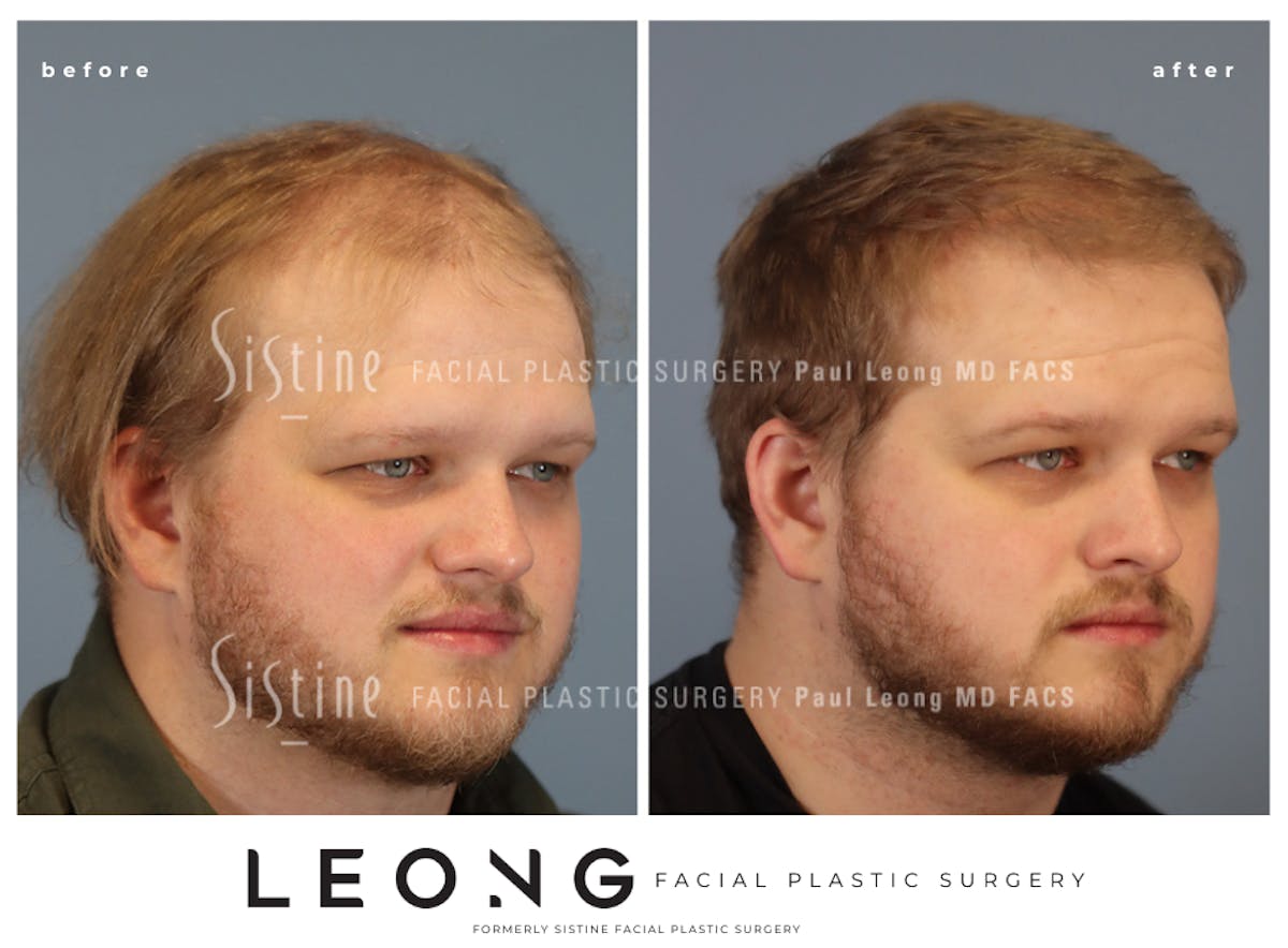 Hair Transplant Before & After Gallery - Patient 297398 - Image 3