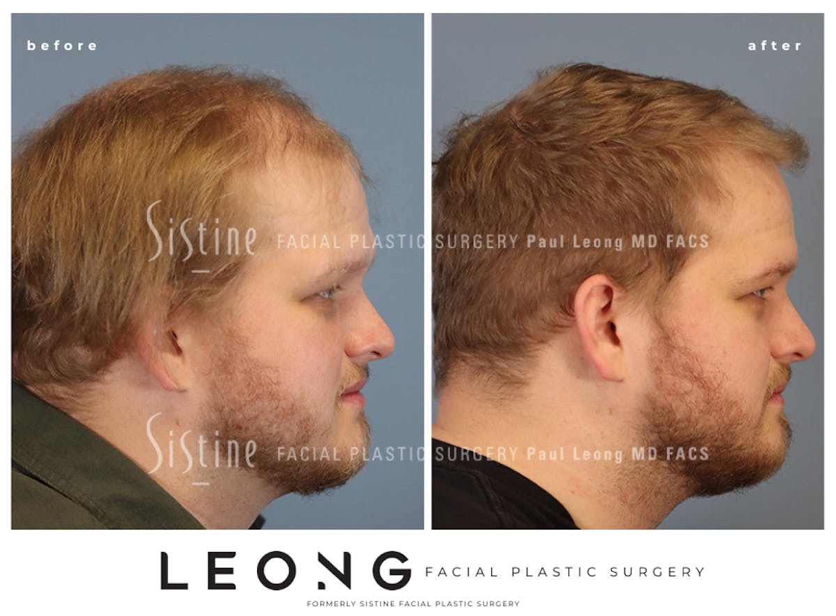 Hair Transplant Before & After Gallery - Patient 297398 - Image 4