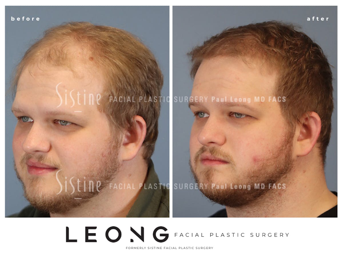 Hair Transplant Before & After Gallery - Patient 297398 - Image 5