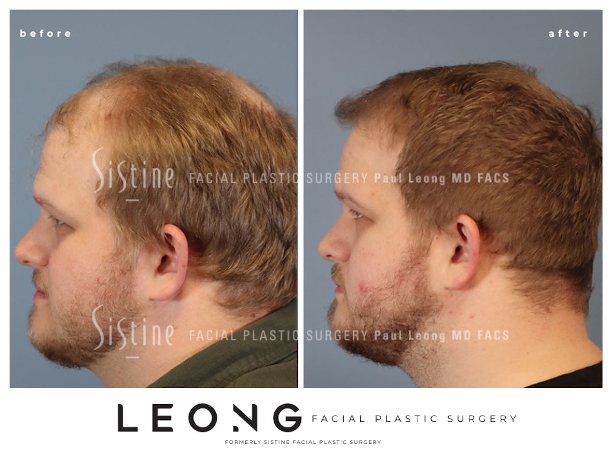 Hair Transplant Before & After Gallery - Patient 297398 - Image 6