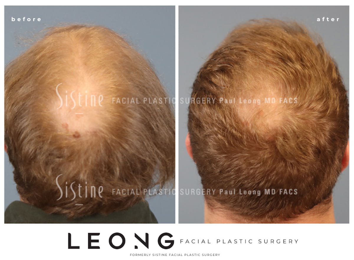 Hair Transplant Before & After Gallery - Patient 297398 - Image 7