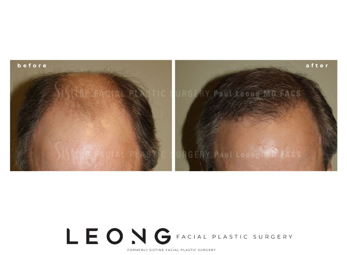 Hair Transplant Before & After Gallery - Patient 304923 - Image 1